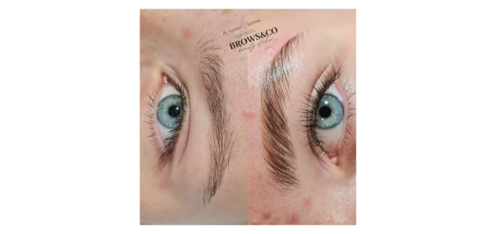 Brow lift/žene