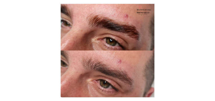 Brow lift/muškarci