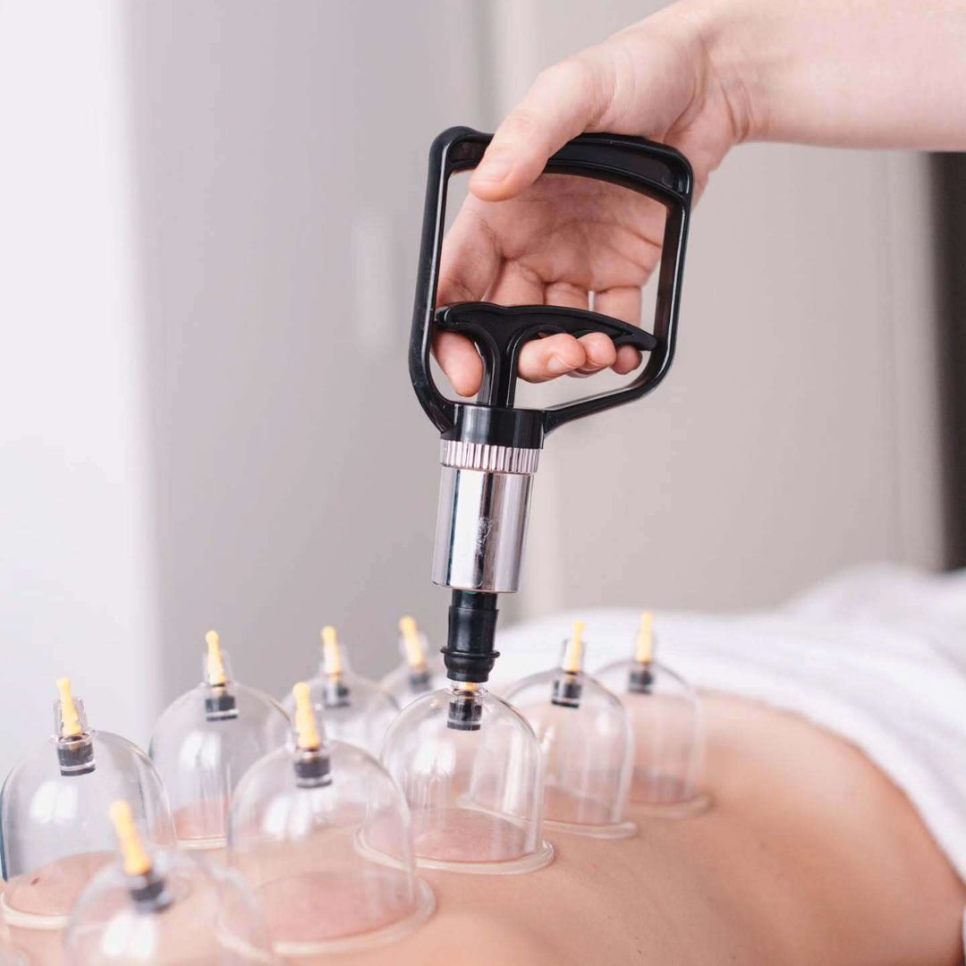 Cupping terapija, poznata i kao 𝘃𝗮𝗸𝘂𝘂𝗺𝘀𝗸𝗮 𝘁𝗲𝗿𝗮𝗽𝗶𝗷𝗮, koristi se za poboljšanje krvotoka i smirivanje tijela već stoljećima. Evo kako:

🌱 𝗣𝗼𝗯𝗼𝗹𝗷š𝗮𝘃𝗮 𝗽𝗿𝗼𝘁𝗼𝗸 𝗸𝗿𝘃𝗶 𝗶 𝗸𝗶𝘀𝗶𝗸𝗮 𝘂 𝘁𝗸𝗶𝘃𝘂
Cupping stvara vakuum koji privlači kožu i potkožno tkivo u čašice, uzrokuje širenje kapilara i povećanje protoka krvi na tretiranom području što donosi više kisika i hranjivih tvari u tkivo

🌱 𝗢𝘀𝗹𝗼𝗯𝗮đ𝗮 𝗯𝗹𝗼𝗸𝗮𝗱𝗲 𝗶 𝗻𝗮𝗽𝗲𝘁𝗼𝘀𝘁 𝘂 𝗺𝗶š𝗶ć𝗶𝗺𝗮
Cupping razbija adhezije (lijepljenja tkiva) i smanjuje zategnutost, što pomaže mišićima da se opuste i bolje funkcioniraju.

🌱 𝗣𝗼𝘁𝗶č𝗲 𝗹𝗶𝗺𝗳𝗻𝘂 𝗱𝗿𝗲𝗻𝗮ž𝘂 𝗶 𝗲𝗹𝗶𝗺𝗶𝗻𝗮𝗰𝗶𝗷𝘂 𝘁𝗼𝗸𝘀𝗶𝗻𝗮
Ubrzava prirodni proces detoksikacije, što doprinosi smanjenju upala, natečenosti i poboljšava opće zdravlje.

🌱 𝗦𝗺𝗮𝗻𝗷𝘂𝗷𝗲 𝘂𝗽𝗮𝗹𝘂 𝗶 𝘂𝗯𝗿𝘇𝗮𝘃𝗮 𝘇𝗮𝗰𝗷𝗲𝗹𝗷𝗶𝘃𝗮𝗻𝗷𝗲
Cupping terapija povećava protok krvi u ozlijeđenim ili upaljenim područjima, čime se poboljšava sposobnost tijela da brže zacjeljuje.

🌱 𝗣𝗼𝗺𝗮ž𝗲 𝘂 𝘀𝗺𝗮𝗻𝗷𝗲𝗻𝗷𝘂 𝗯𝗼𝗹𝗶 𝗶 𝗸𝗿𝗼𝗻𝗶č𝗻𝗶𝗵 𝗯𝗼𝗹𝗻𝗶𝗵 𝘀𝘁𝗮𝗻𝗷𝗮
Cupping potiče oslobađanje endorfina, prirodnih hormona za ublažavanje boli. Cupping može biti vrlo učinkovit za osobe s kroničnim bolovima, glavoboljama, migrenama i bolovima u zglobovima.

🌱 𝗢𝗽𝘂š𝘁𝗮 ž𝗶𝘃č𝗮𝗻𝗶 𝘀𝘂𝘀𝘁𝗮𝘃
Cupping terapija ima smirujući učinak na živčani sustav, potičući parasimpatički odgovor („odmor i probava“) tijela.

🌱 𝗘𝗹𝗮𝘀𝘁𝗶č𝗻𝗼𝘀𝘁 𝗶 𝘇𝗱𝗿𝗮𝘃𝗹𝗷𝗲 𝗸𝗼ž𝗲
Cupping može poboljšati elastičnost kože jer povećani protok krvi donosi više hranjivih tvari do površine kože. Također, tretman može pomoći u smanjenju ožiljaka i strija, poboljšavajući općeniti izgled kože.

🌱 𝗕𝗿ž𝗶 𝗼𝗽𝗼𝗿𝗮𝘃𝗮𝗸 𝗻𝗮𝗸𝗼𝗻 𝗳𝗶𝘇𝗶č𝗸𝗼𝗴 𝗻𝗮𝗽𝗼𝗿𝗮
Cupping pomaže u otklanjanju nakupljene mliječne kiseline i drugih metabolita iz mišića nakon fizičkog napora.

🌱 𝗢𝗽𝘂š𝘁𝗮 𝗶 𝘀𝗺𝗶𝗿𝘂𝗷𝗲
Mnogi ljudi doživljavaju dubok osjećaj opuštenosti nakon cupping tretmana. Stimulacijom cirkulacije i otpuštanjem napetosti, tijelo i um dolaze u stanje relaksacije, što smanjuje tjeskobu, stres i nervozu.

Tu sam za sva pitanja!
