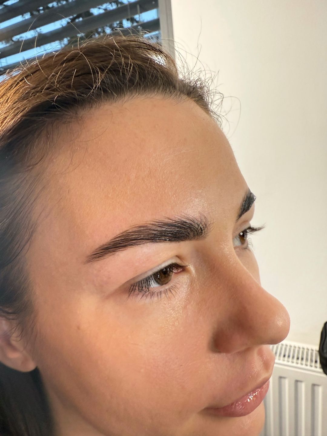 Brow lift