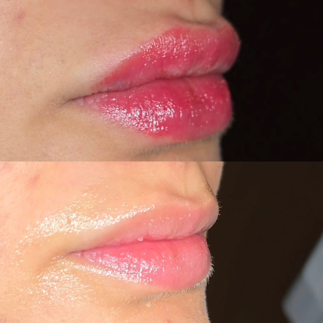 Usne ove sinjorine smo uljepšali sa 0,7 ml Teosyal kiss filerom.💋