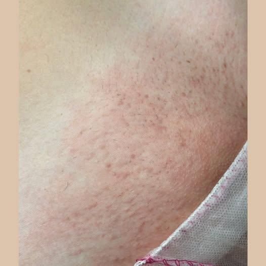 Često nas pitate kako koža reagira nakon laserske epilacije.
Na fotografiji je primjer najizraženije reakcije koju smo do sada vidjeli nakon tretmana bikini zone.
👉 Crvenilo je potpuno nestalo već nakon pola sata, što pokazuje koliko su reakcije minimalne i prolazne.
Na slici možete vidjeti kožu nakon samo dva tretmana lasera – rezultat je već vidljiv, a koža ostaje glatka i nježna.
✨ Laserska epilacija je sigurna i učinkovita, a mi smo ovdje da odgovorimo na sva vaša pitanja!