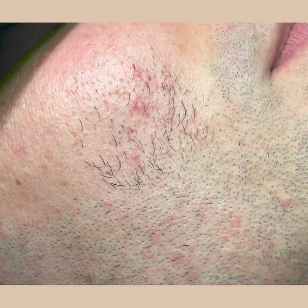 Muškarac u beauty salonu?!?
Nekad iznenađenje, danas standard! Sve više muškaraca prepoznaje važnost njege kože i redovito dolaze na tretmane.
Ne možemo sakriti koliko smo ponosni na ovu promjenu – sretni smo što brojimo ozbiljan broj muških klijenata! Bravo za sve muškarce koji odluče brinuti o sebi jer ljepota i njega nisu luksuz nego potreba. Pa i oni imaju kožu i njene probleme, zar ne?
Klijent se suočavao s učestalim upalnim procesima na licu i dlakama. Nakon samo dva tretmana laserom, stanje kože je znatno bolje, a dlačice nestaju.
Sve više muškaraca bira lasersko uklanjanje dlačica – za glatku kožu bez iritacija i uraslih dlačica.