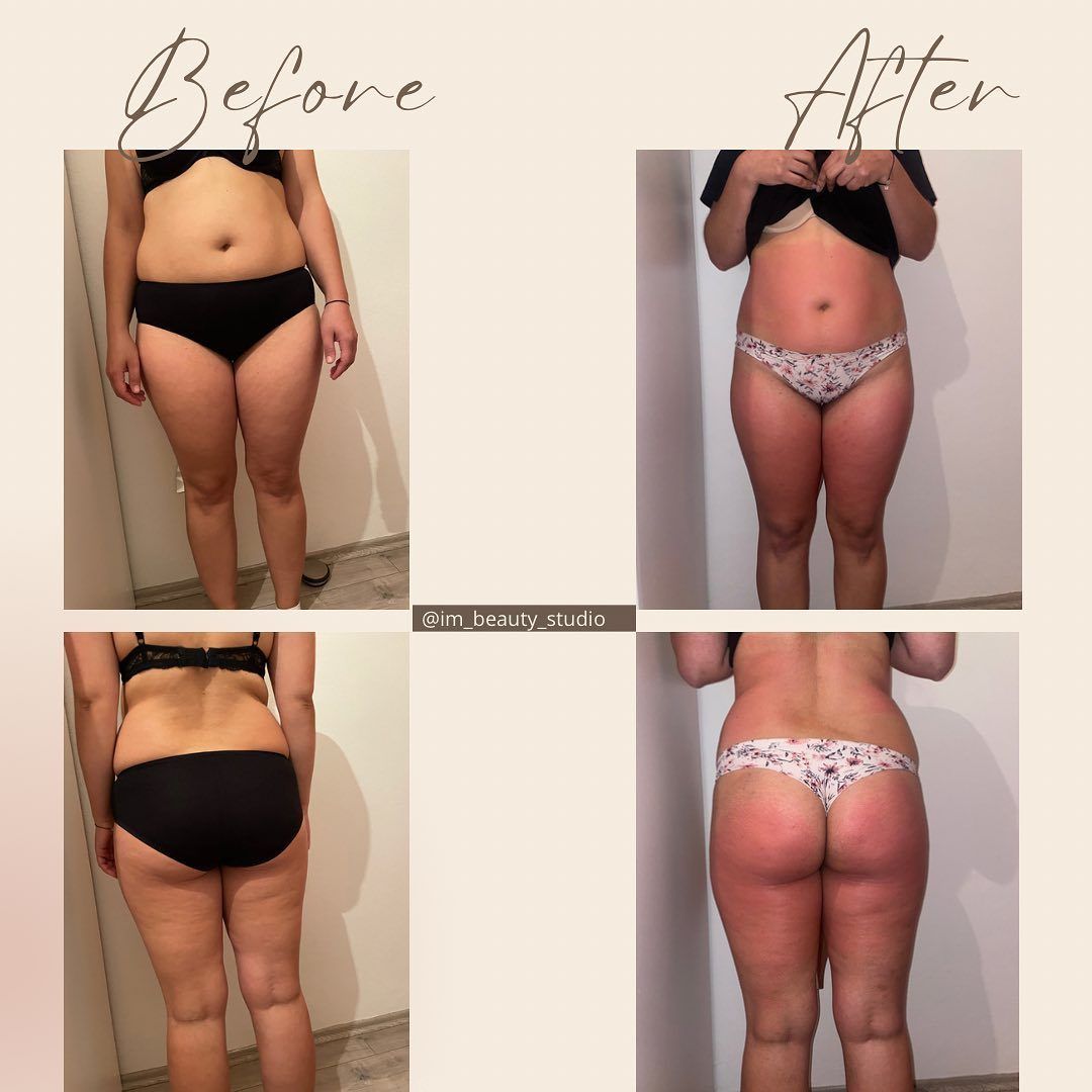 ✨Rezultati nakon odrađenih 5 maderoterapija, 3 body wrappinga i 2 anticelulitna pilinga.✨

✨Pri svakom dolasku klijenta odrađujemo mjerenje i fotografiranje te sve bilježimo u karton klijenta, postupak ponavljamo na sredini odrađenog paketa te na samom kraju paketa. Nakon toga dogovaramo se o daljnjim procesima i što je potrebno učiniti da klijent dođe do određenih i željenih rezultata. Kroz cijeli proces klijent dobiva sve tople preporuke i savjete što može dodatno učiniti da bi ubrzao rezultate.
Zagovaramo samo zdravi način mršavljenja i oblikovanja cijelog tijela sukladno tome da je svako tijelo različito.✨

✨Ovi rezultati su dobiveni bez mijenjanja prehrane svakako trudimo se motivirati da se i to primjeni, ali za svaku naviku potrebno je 40 dana da bi ju izbacili/zamjenili/utemeljili✨

Želimo pohvaliti ove rezultate i nastavljamo dalje!☺️🍀

✨Napomena: fotografije se objavljuju samo uz suglasnost osobe koja je na fotografiji! ✨