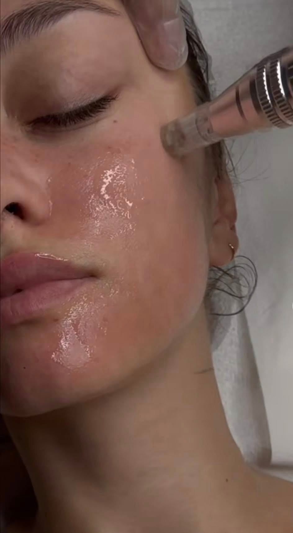 Upoznajte se s našim tretmanom DERMAPEN
Dermapen tretman na vrlo siguran i neinvazivan način učinkovito uklanja sitne bore, poboljšava teksturu i elastičnost kože, te nejednako pigmentiranu kožu.
Također uspješno tretiramo ožiljke nakon akni, ali i hipertrofične ožiljke.
No važno je napomenuti da se radi o stimulativnoj metodi koja općenito, bez obzira na problematiku djeluje revitalizirajuće na kožu i možemo je uvrstiti u još jednu nekiruršku metodu liftinga. Dermapen prirodnim putem stimulira obnovu kože i lučenje kolagena; pore postaju uže, ožiljci se izravnavaju, koža postaje ujednačenija, glađa, napetija, te mlađeg izgleda. 
Mikroiglice, čija je dužina  podesiva (ovisno o tipu, debljini kože) izazivaju vertikalne ubode na koži te tako izazivaju površinsko mikro oštećenje kože i potiču na njenu obnovu. Na taj način potiče se proizvodnja kolagena i tako se koža prirodnim procesom pomlađuje.