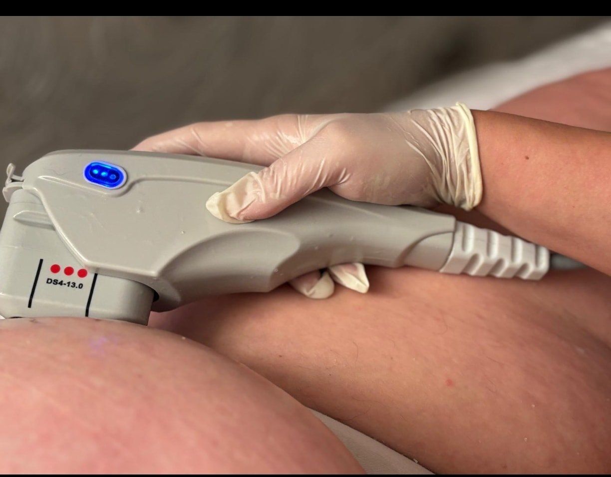 HIFU (High Intensity Focused Ultrasound) za tijelo je neinvazivni tretman koji koristi fokusiranu ultrazvučnu energiju za razgradnju masnih naslaga i celulita te istovremeno potiče stvaranje novog kolagena i elastina, što rezultira zatezanjem kože i oblikovanjem tijela. Tretman se izvodi na specifičnim dubinama kože i potkožnog tkiva kako bi se postigli termalni učinci bez oštećenja okolnog tkiva, a rezultati postaju vidljivi postupno, kako se aktivira prirodni proces obnove tkiva.

Kako djeluje HIFU za tijelo?

Fokusirana ultrazvučna energija:

Aparat emitira ultrazvučnu energiju koja se fokusira na točno određene točke u dubljim slojevima kože i potkožnog tkiva.

Toplinski učinak:

Ta energija zagrijava tkivo na temperaturu od oko 60-70°C, što stvara kontrolirane toplinske lezije.

Poticanje obnove:

Tijelo na te lezije reagira aktiviranjem procesa zarastanja, što potiče proizvodnju novog kolagena i elastina te preuređivanje vezivnog tkiva.

Razgradnja masnih stanica:

Istovremeno, ultrazvučna energija razgrađuje masne stanice i celulit, koji se kasnije prirodnim putem uklanjaju iz tijela.

Za što se koristi? Oblikovanje tijela, Smanjenje lokaliziranih masnih naslaga, Redukcija celulita, Zatezanje opuštene kože tijela, Redukcija strija.

Prednosti HIFU tretmana:

Neinvazivan: Nema potrebe za rezovima, anestezijom niti oporavkom.

Precizan: Energija se isporučuje ciljano na željene dubine.

Dugotrajni rezultati: Učinci se razvijaju postupno i mogu trajati do dvije godine.

Maksimalna udobnost: Tretman je ugodan i bezbolan.