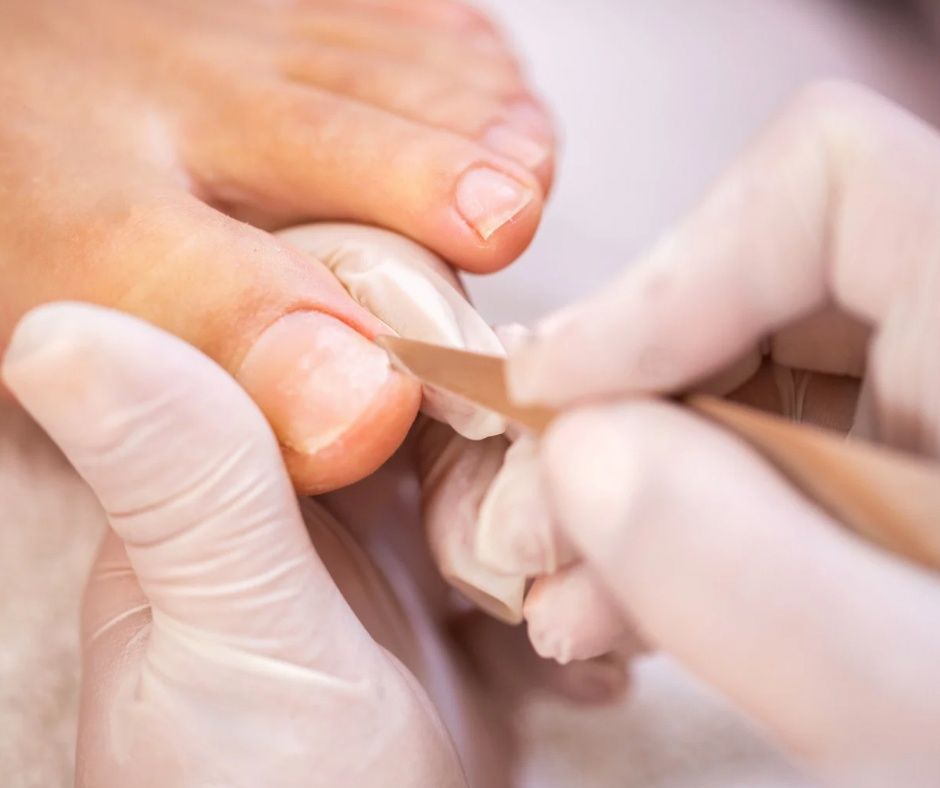 Medicinska pedikura je specijalizirani tretman koji nadilazi klasičnu njegu, a usmjeren je na rješavanje konkretnih problema stopala i noktiju. Izvodi je educirano osoblje s dodatnim znanjima iz područja podologije ili medicinske njege stopala, uz poštivanje stroge higijene i sterilizacije instrumenata.

Ovaj tretman preporučuje se osobama koje imaju poteškoće poput zadebljale ili ispucale kože, uraslih noktiju, kurjih očiju, gljivičnih promjena ili bolnih žuljeva – ali i svima koji žele preventivnu, temeljitu njegu stopala kako bi očuvali njihovo zdravlje i funkcionalnost.

Medicinska pedikura dostupna je u našem estetskom centru u Centru Cvjetni, gdje se tretmani izvode stručno, precizno i s pažnjom prema individualnim potrebama svakog klijenta.