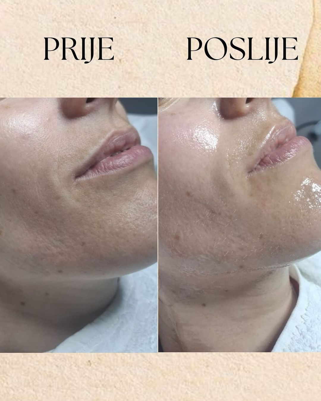 HYDRAFACIAL
Zdrava i njegovana koža je u modi!
